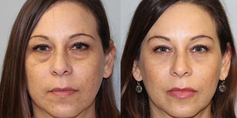 Boston Eyelid Surgeon