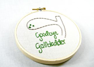 gall bladder stone treatment