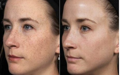 Laser resurfacing
