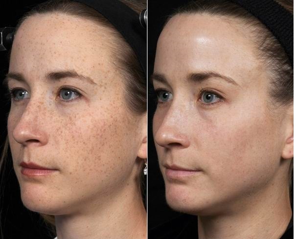Laser resurfacing