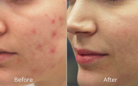 laser resurfacing